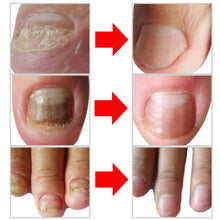 Ladda upp bild till gallerivisning, Nail Fungal Treatment Repair Essence Serum Paronychia Onychomycosis Anti Infection Care Foot Fungus Removal Gel